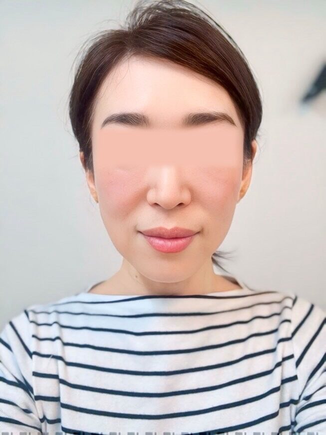 小顔矯正・美容鍼ビフォー